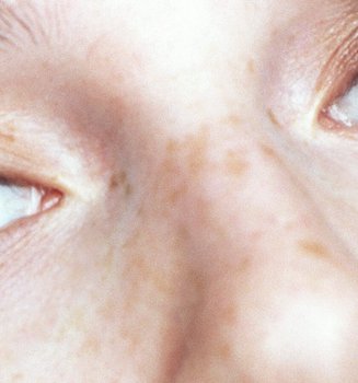 How To Choose The Right Concealer To Banish Dark Circles Hero